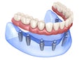 Maxillary and Mandibular prosthesis with gum All on 8 system supported by implants. Medically accurate 3D illustration of human