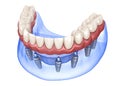 Maxillary and Mandibular prosthesis with gum All on 8 system supported by implants. Medically accurate 3D illustration of human