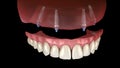 Maxillary prosthesis All on 4 system supported by implants. Medically accurate 3D animation of human teeth and dentures