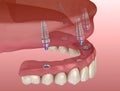Maxillary prosthesis with gum All on 4 system supported by implants. Medically accurate 3D illustration of human teeth
