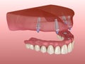 Maxillary prosthesis with gum All on 4 system supported by implants. Medically accurate 3D illustration of human teeth Royalty Free Stock Photo