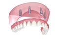 Maxillary prosthesis with gum All on 4 system supported by implants. Medically accurate 3D illustration of human teeth and Royalty Free Stock Photo