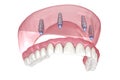 Maxillary prosthesis with gum All on 4 system supported by implants. Medically accurate 3D illustration of human teeth and