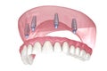 Maxillary prosthesis with gum All on 4 system supported by implants. Medically accurate 3D illustration of human teeth and