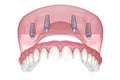 Maxillary prosthesis with gum All on 4 system supported by implants. Medically accurate 3D illustration of human teeth and Royalty Free Stock Photo