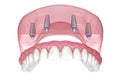 Maxillary prosthesis with gum All on 4 system supported by implants. Medically accurate 3D illustration of human teeth and