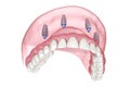 Maxillary prosthesis with gum All on 4 system supported by implants. Medically accurate 3D illustration of human teeth and Royalty Free Stock Photo