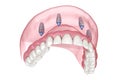 Maxillary prosthesis with gum All on 4 system supported by implants. Medically accurate 3D illustration of human teeth and