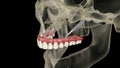 Maxillary prosthesis supported by zygomatic implants. Medically accurate 3D animation of human teeth and dentures