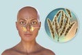 Maxillary rhinosinusitis due to fungi Fusarium, 3D illustration Royalty Free Stock Photo