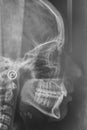 Maxilofacial X-Ray for a dentist treatment. Orthodontics diagnosis