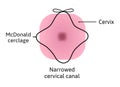 McDonald cerclage tightening of cervix opening during pregnancy. Anatomy of cervical canal. cervix weakness and black