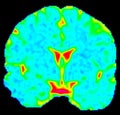 Mean Diffusivity Brain Map in Coronal View Royalty Free Stock Photo