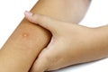 Measles on arm Royalty Free Stock Photo