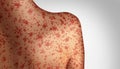 Measles Concept Royalty Free Stock Photo