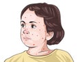 Measles is a highly contagious infectious disease caused by the measles virus