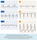 Measurement reference point for cardiac cycle Royalty Free Stock Photo