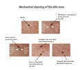 Mechanical cleaning of the skin from acne