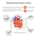 Mechanical heart valve. Vector, Illustration Design. Royalty Free Stock Photo
