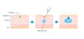 Mechanism illustration of hyaluronic acid injection (cross-sectional view of the skin