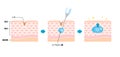 Mechanism illustration of hyaluronic acid injection (cross-sectional view of the skin