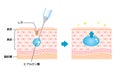 Mechanism illustration of hyaluronic acid injection (cross-sectional view of the skin