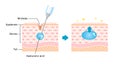 Mechanism illustration of hyaluronic acid injection (cross-sectional view of the skin