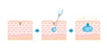 Mechanism illustration of hyaluronic acid injection (cross-sectional view of the skin