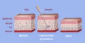 Mechanism of liposuction. Suction-assisted liposuction.