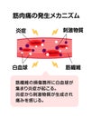 Mechanism of muscle soreness vector illustration