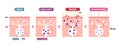 Mechanism of shingles ( herpes zoster ) vector illustration (including postherpetic neuralgia