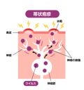 Mechanism of shingles ( herpes zoster ) vector illustration Royalty Free Stock Photo