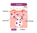 Mechanism of shingles ( herpes zoster ) vector illustration Royalty Free Stock Photo