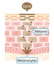 Human skin layer of melanin and facial dark spots. Infographic skin layer illustration. Beauty and skin care concept