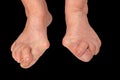 Medecin, valgus bunion, leg with deformation valgus hallux Bunion, consequence of failure of treatment, isolated on the black