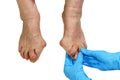 Medecin, valgus bunion, leg with deformation valgus hallux Bunion Royalty Free Stock Photo