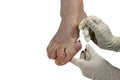 Medecin, valgus bunion, leg with deformation valgus hallux Bunion