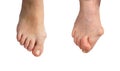 Medetcin, valgus bunion, Initial stage and advanced stage of the disease , leg with deformity valgus hallux Bunion,
