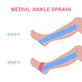 Medial ankle sprain. Correct kinesiology taping.