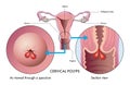 Medial Illustration Of Female Reproductive System With Cervical Polyps 