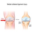 Medial knee injuries Royalty Free Stock Photo