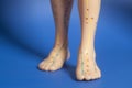 Medical acupuncture model of human feet on blue