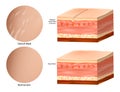 Medical Anatomy Skin Stretch Marks. Normal skin and Stretch Mark. Collagen elastin. Royalty Free Stock Photo