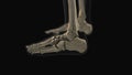 Medical animation of the calcaneus bone pain