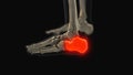 Medical animation of the calcaneus bone pain