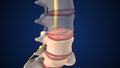 Medical animation of a herniated disc in the lumbar spine Royalty Free Stock Photo