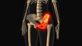Medical animation of the hip bone pain