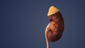 Medical animation of kidney stones in humans