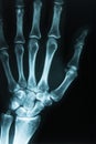 Medical xray scan of a hand