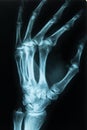 Medical xray scan of a hand